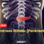 Pankreas İltihabı (Pankreatit) Nedir