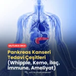 Pankreas Kanseri Tedavi Çeşitleri