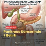 Pankreas Kanserinde 7 Belirti