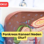 Pankreas Kanseri Neden Olur?