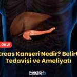 Pankreas Kanseri Nedir? Belirtileri, Tedavisi ve Ameliyatı Nedir